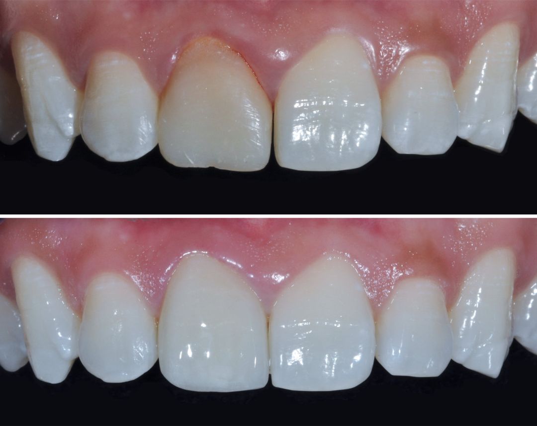 le tooth Crowns Ascot & West End, Brisbane